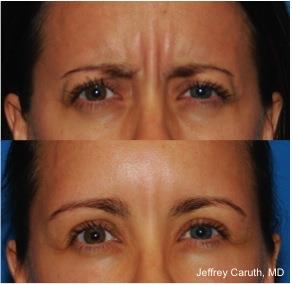 Before and After ThermiRase photos