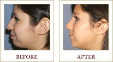 A young brunette woman before and after receiving rhinoplasty.