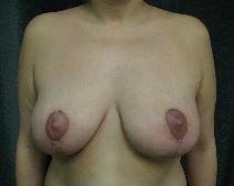 After breast reduction