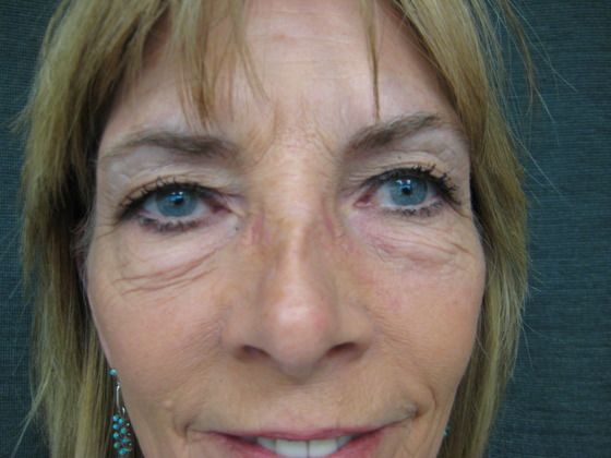 Before eyelid surgery